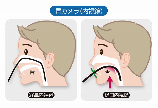 経鼻内視鏡